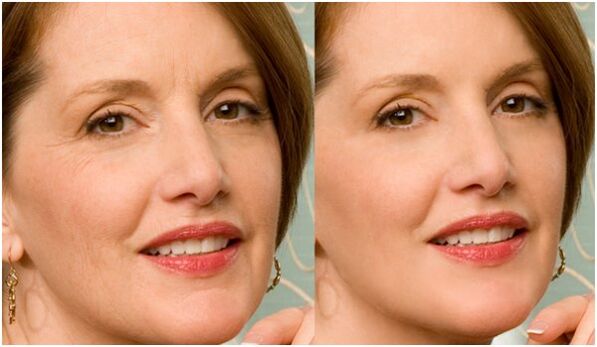 Avant et après le rajeunissement du visage au plasma