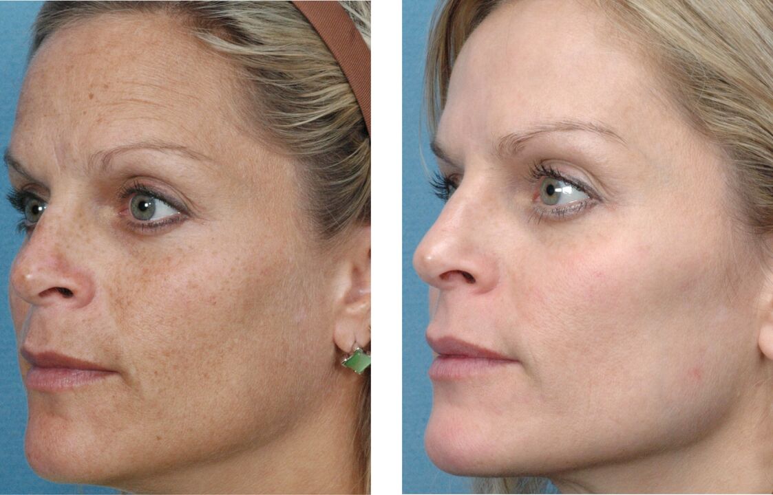 Photos avant et après le rajeunissement de la peau 1