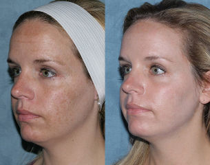 Photos avant et après du rajeunissement du visage
