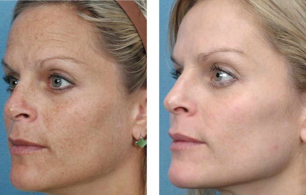 Avant et après le rajeunissement de la peau