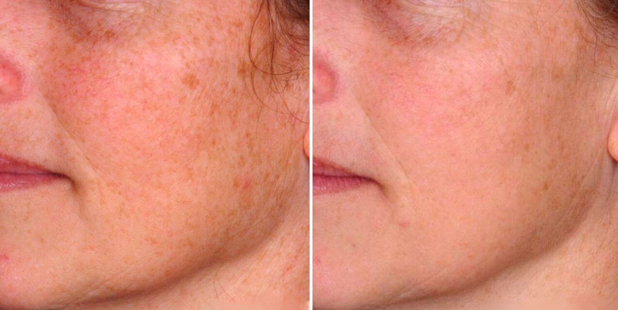 Une partie de l'effet photothermique se traduit par la réduction des taches de vieillesse sur la peau du visage. 
