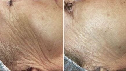 Avant et après le rajeunissement de la peau au laser
