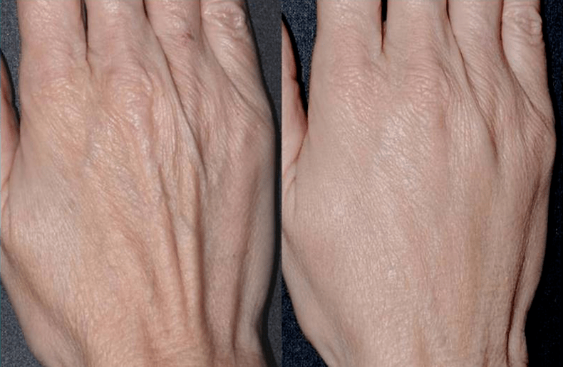 Modelage des contours, rajeunissement des mains photo 2 avant et après